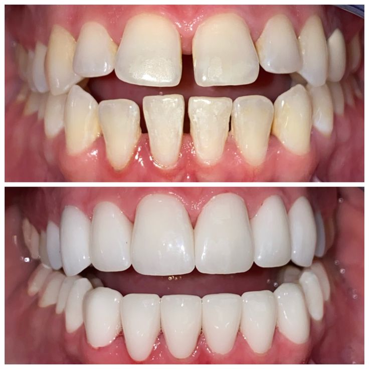 Dental Bonding before and after