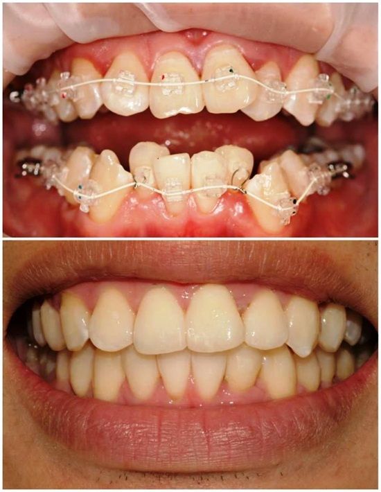 Orthodontic Treatment before and after