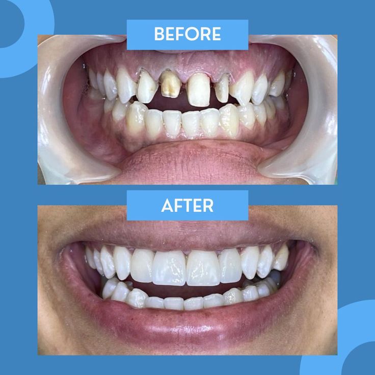Smile Makeover before and after