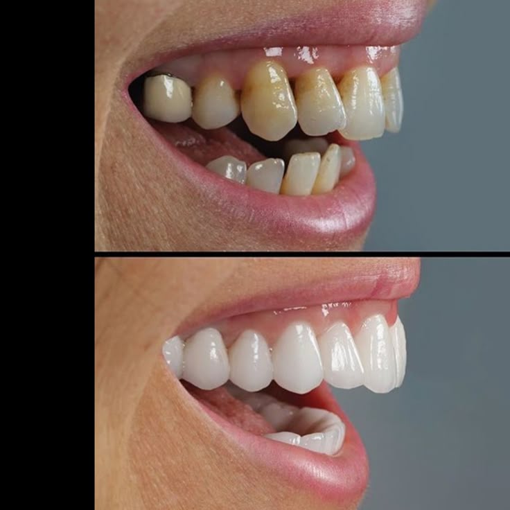 Dental Veneers before and after