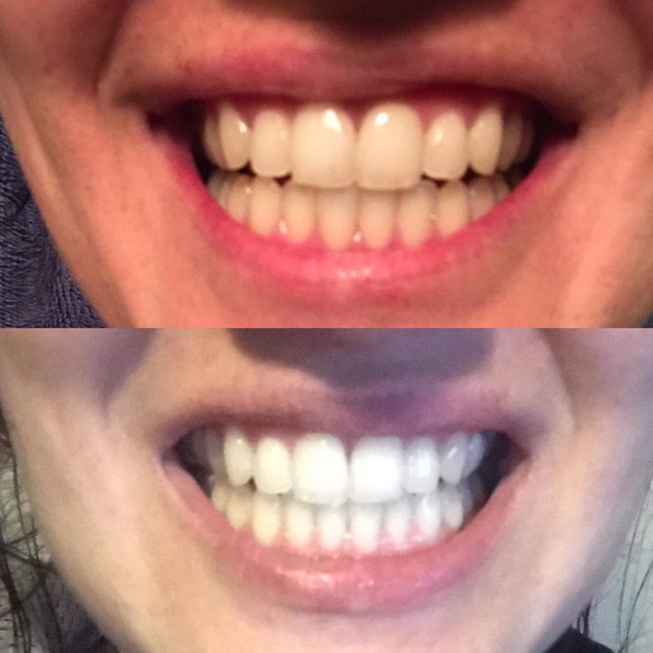 Teeth Whitening before and after